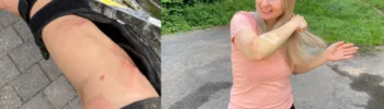 Wundheilung fördern nach Mountainbike Sturz